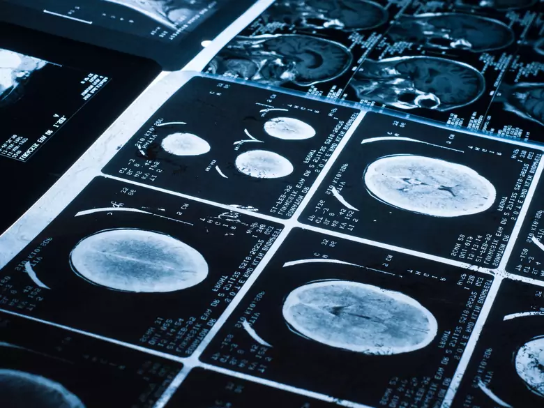 Ryzyko związane z promieniowaniem jonizującym przy badaniu TK u dzieci