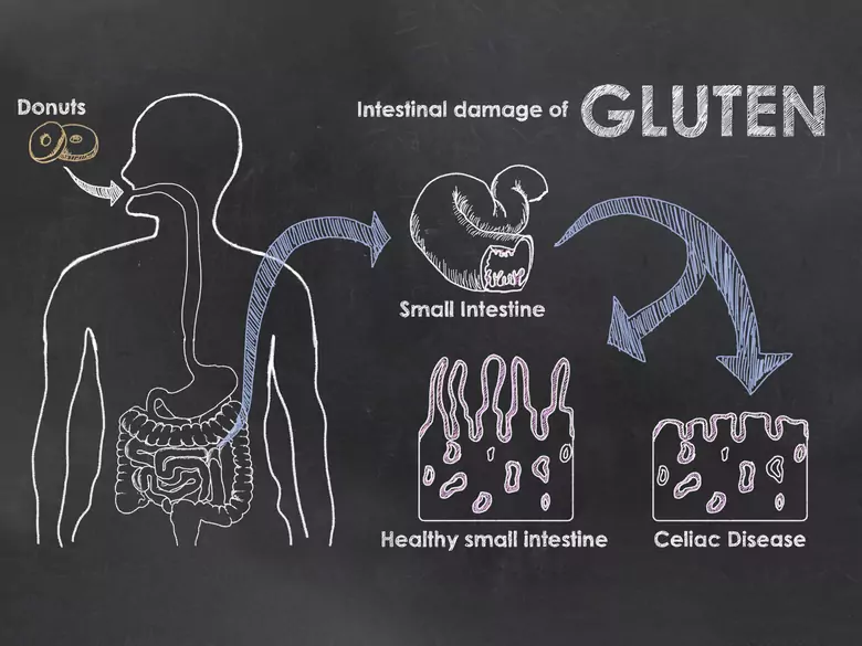 Choroby związane z glutenem to nie tylko celiakia