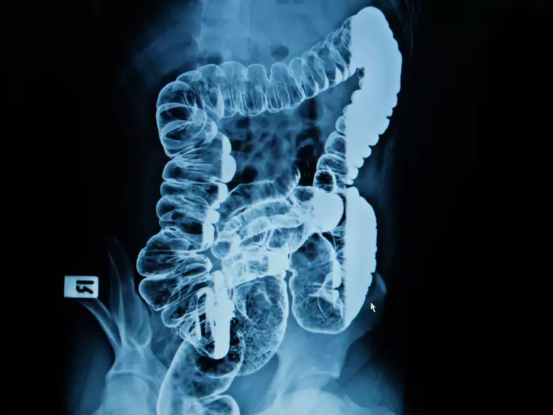 Dobroczynna mikroflora jelitowa – probiotyki