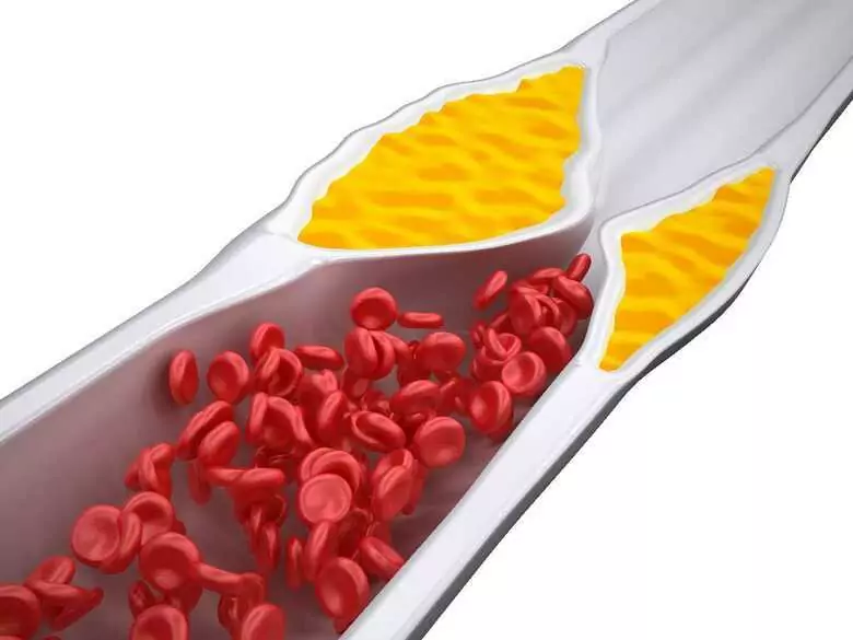 Rodzinna hipercholesterolemia – gdy dziecko ma zbyt wysoki poziom cholesterolu