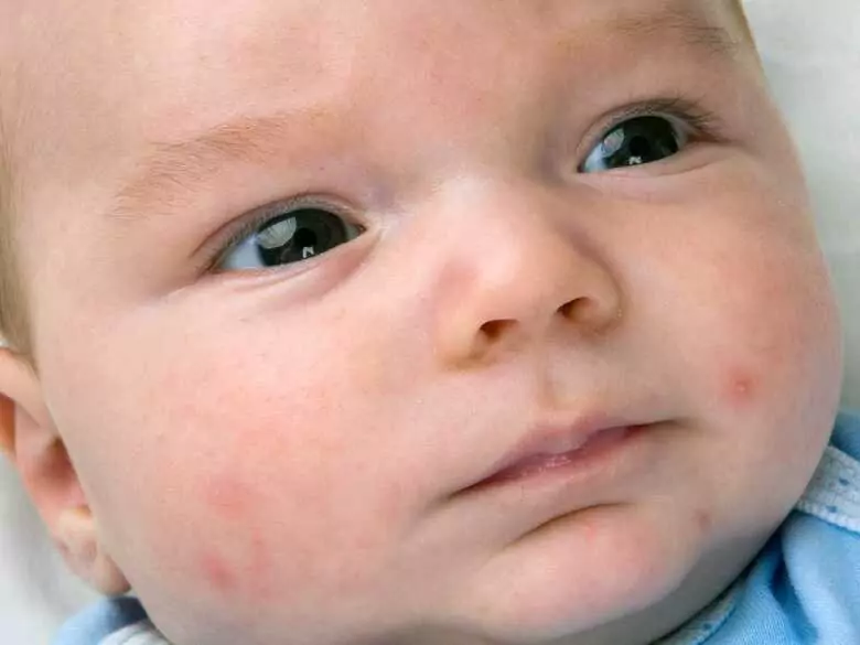 Alergia pokarmowa a wysypka – co powinien wiedzieć każdy rodzic?